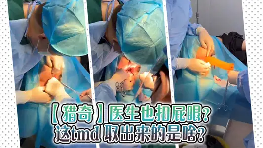 【猎奇】医生也扣屁眼？ 这tmd 取出来的是啥？